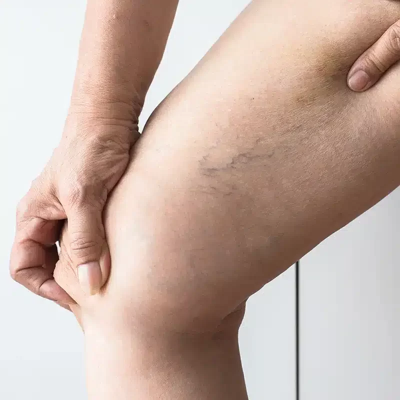 Microphlebectomy 113947180 L 800